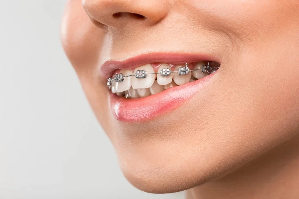 What Age to Get Braces