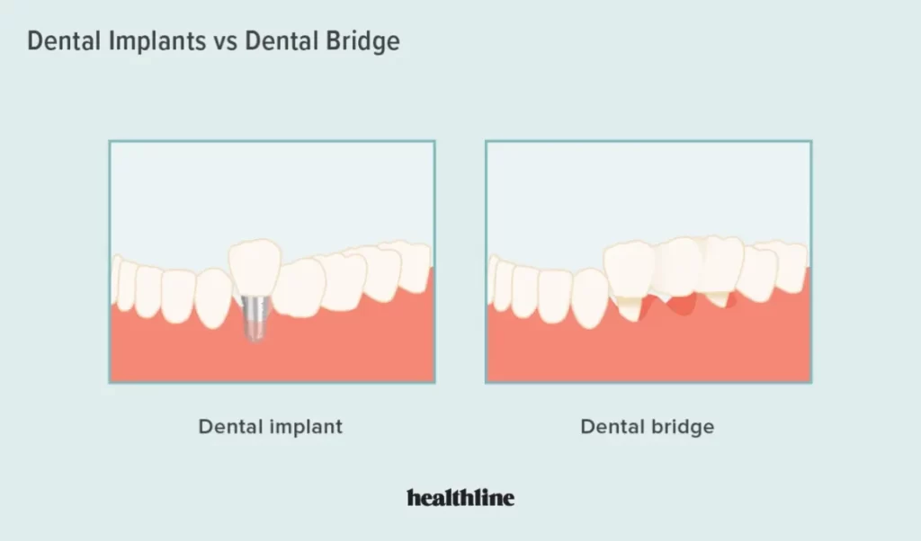 Is a Dental Bridge or Implant Better