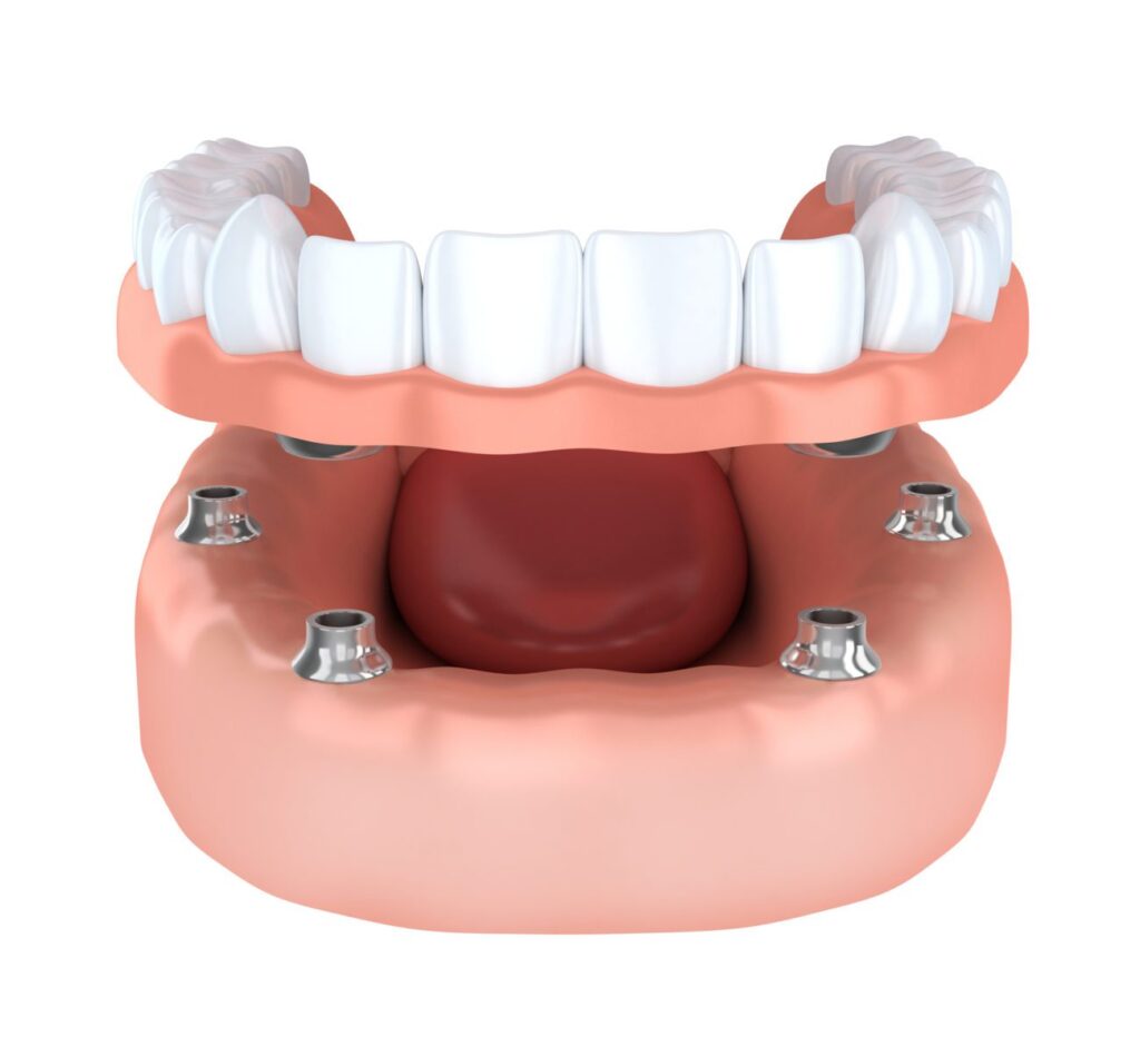 How often should dentures be relined