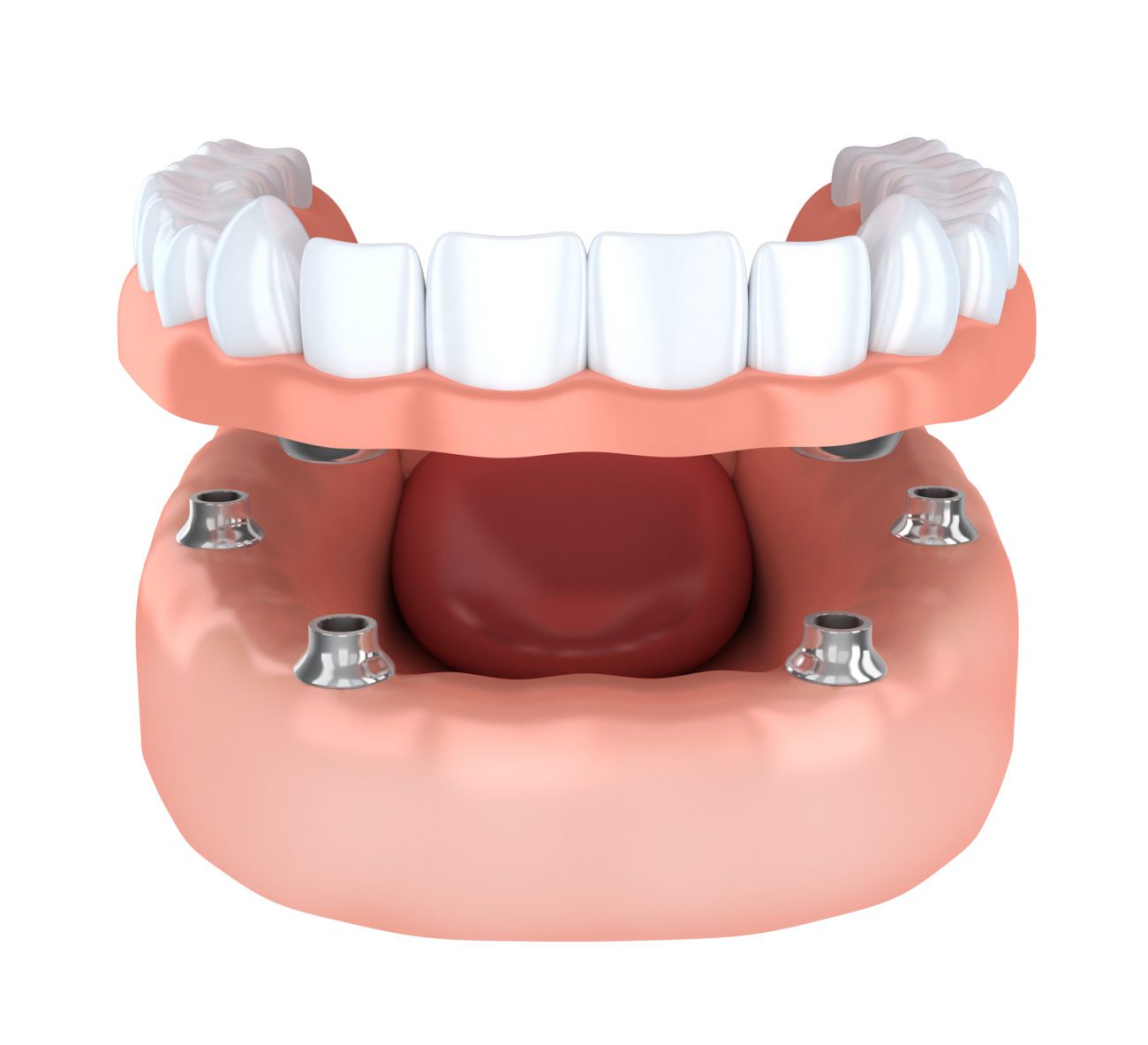 How Often Should Dentures Be Relined Bellesmile Dentistry 