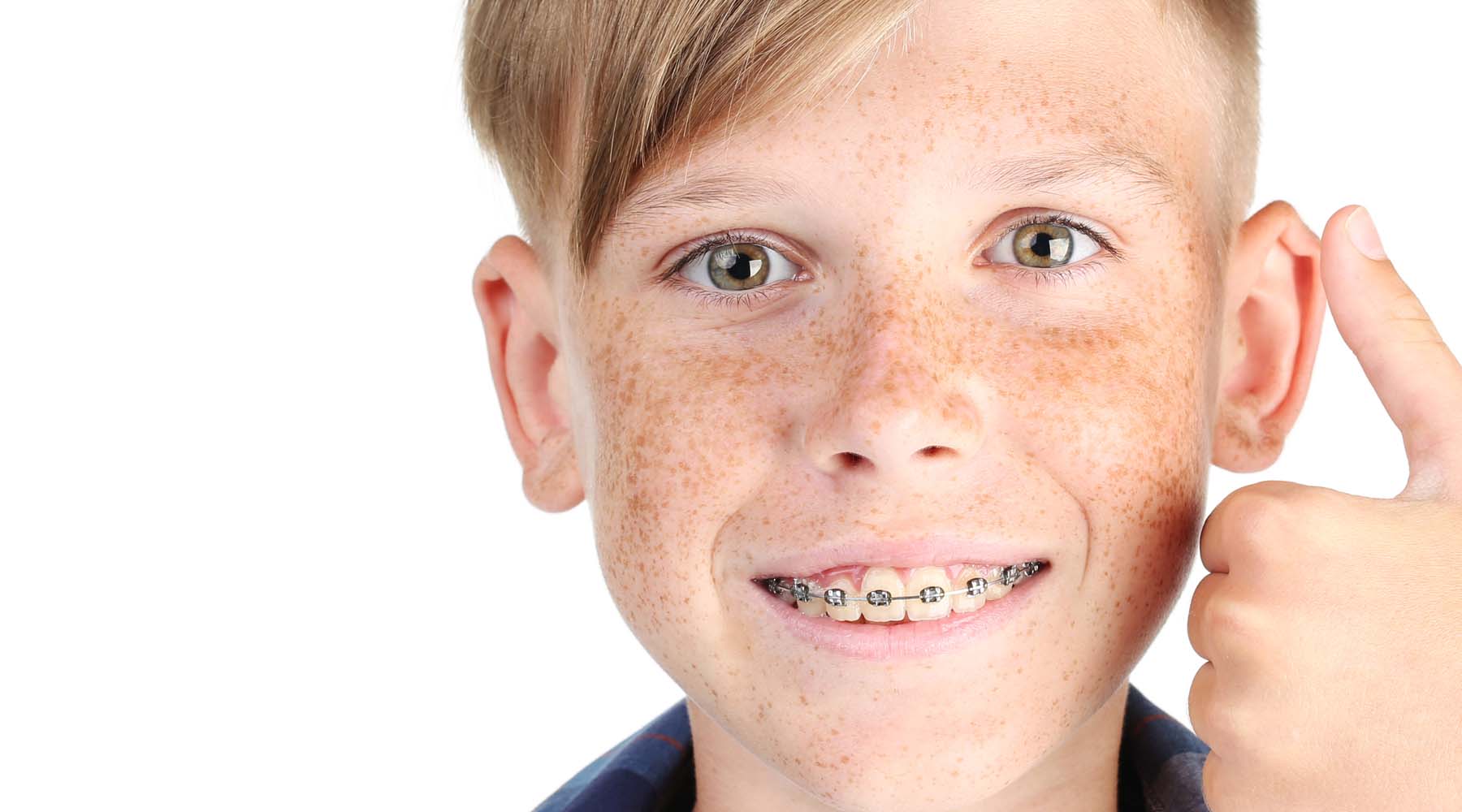 Are Braces Worth It Call Bellesmile Dentistry Now!