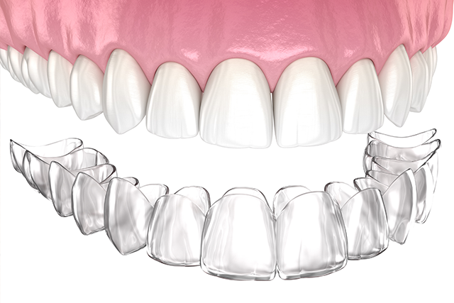 Can you get invisalign with wisdom teeth