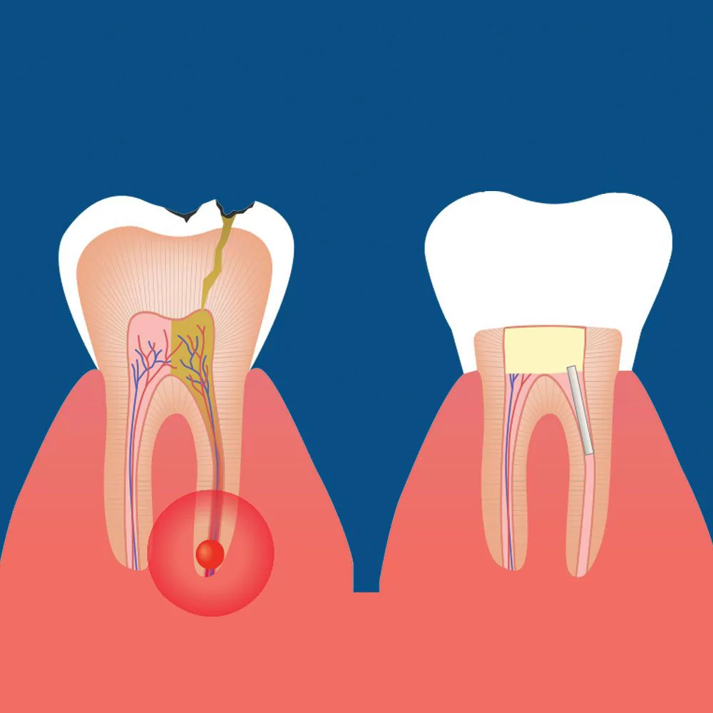 Can root canal cause nerve damage