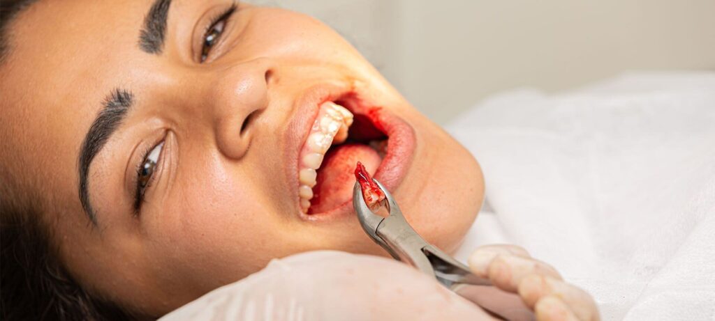 What age do you get your wisdom teeth pulled
