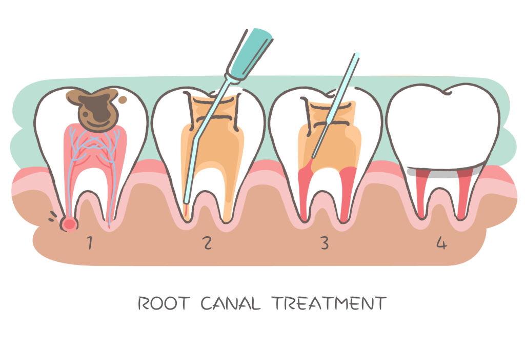 How much does a root canal cost