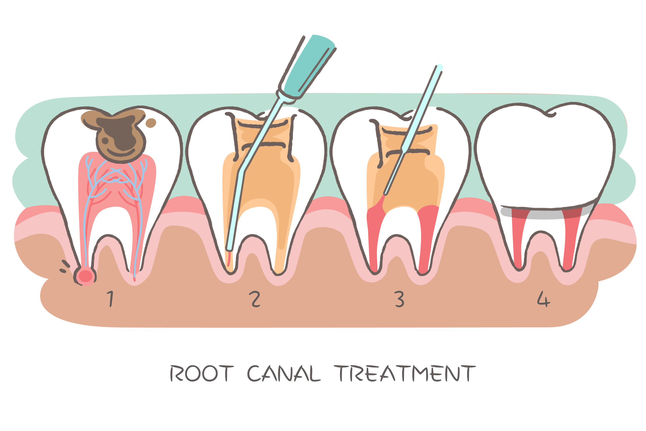 how-much-does-a-root-canal-cost-bellesmile-dentistry