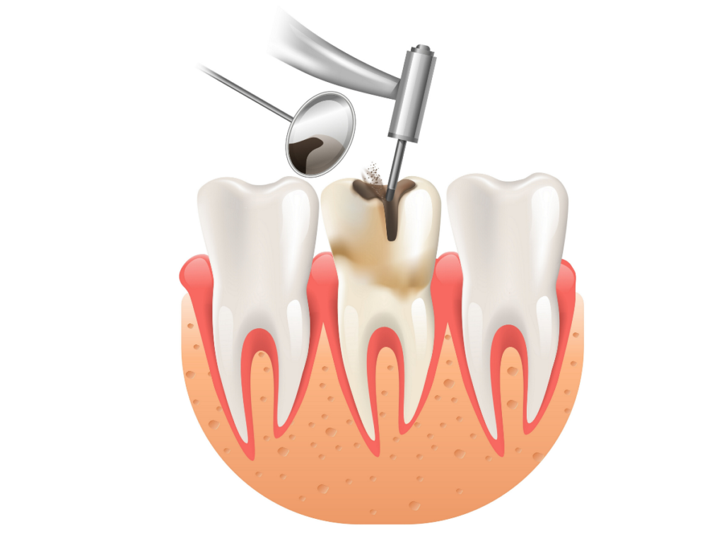 How long do root canals last
