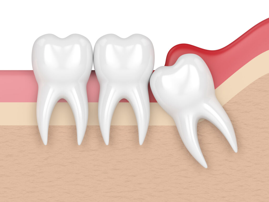 Should Wisdom teeth be removed before braces