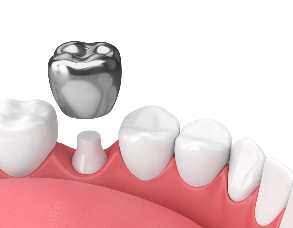 How Much Does a Dental Crown Cost