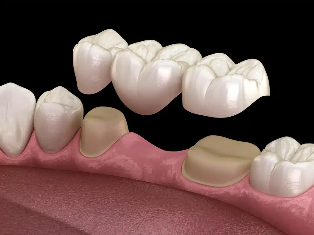 Is a Dental Bridge or Implant Better