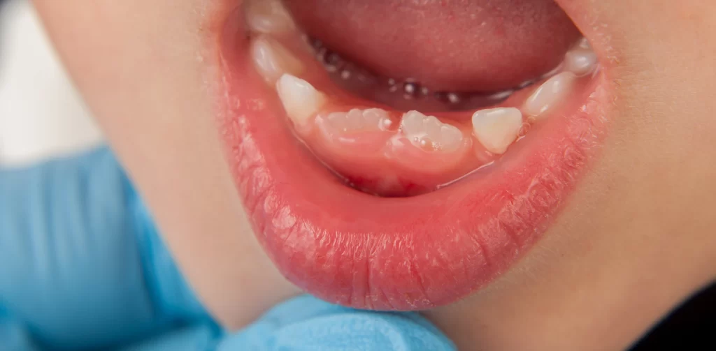Can Cosmetic Dentistry Fix Crooked Teeth
