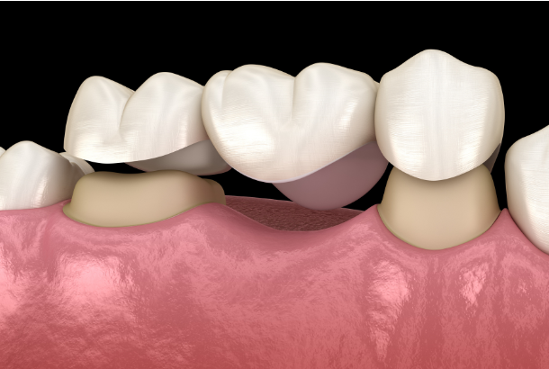 How Long Does a Dental Bridge Last