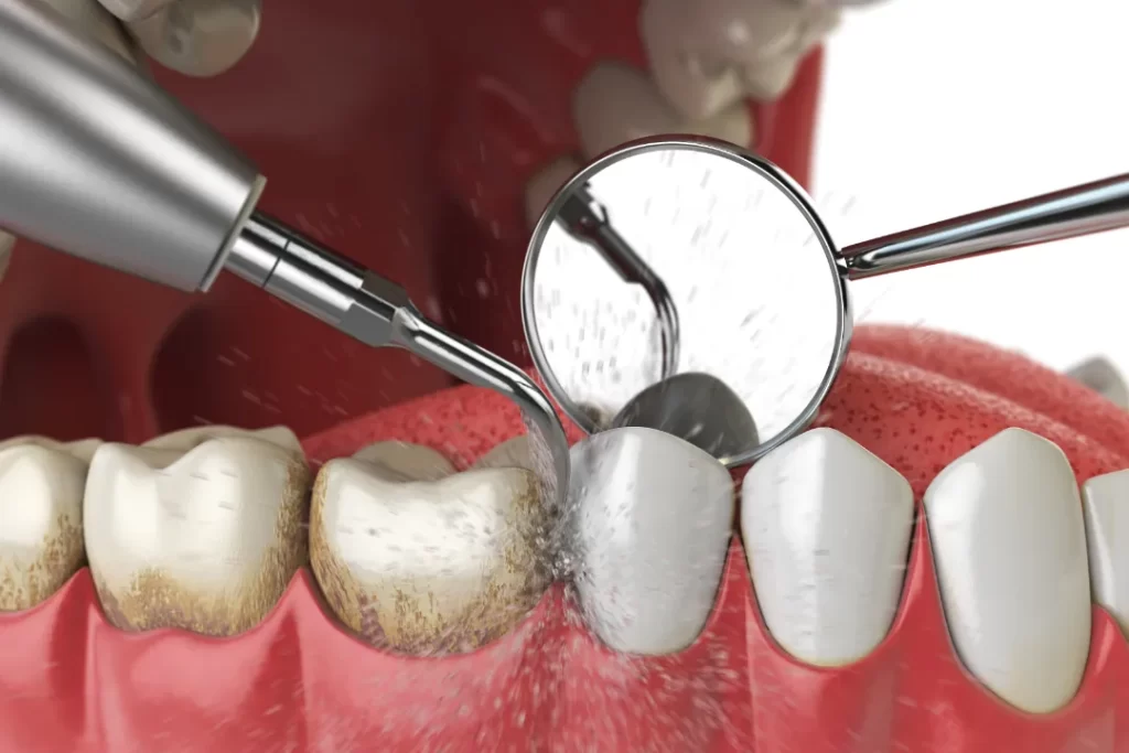 How Much is Teeth Cleaning in Ontario