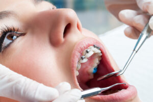 Can I get Invasilign if I already had Braces?