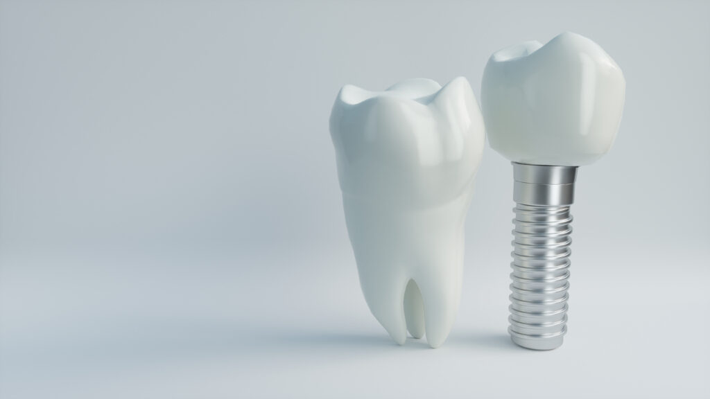 Can You Get Dental Implants After Dentures?