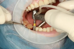 Does ODSP Cover Dental Implants?
